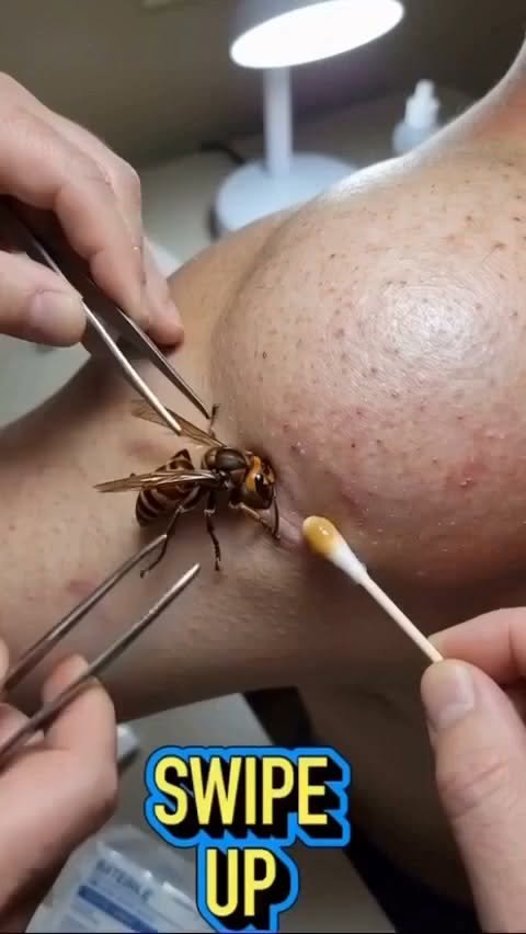 What to Do After a Bee Sting on the Knee