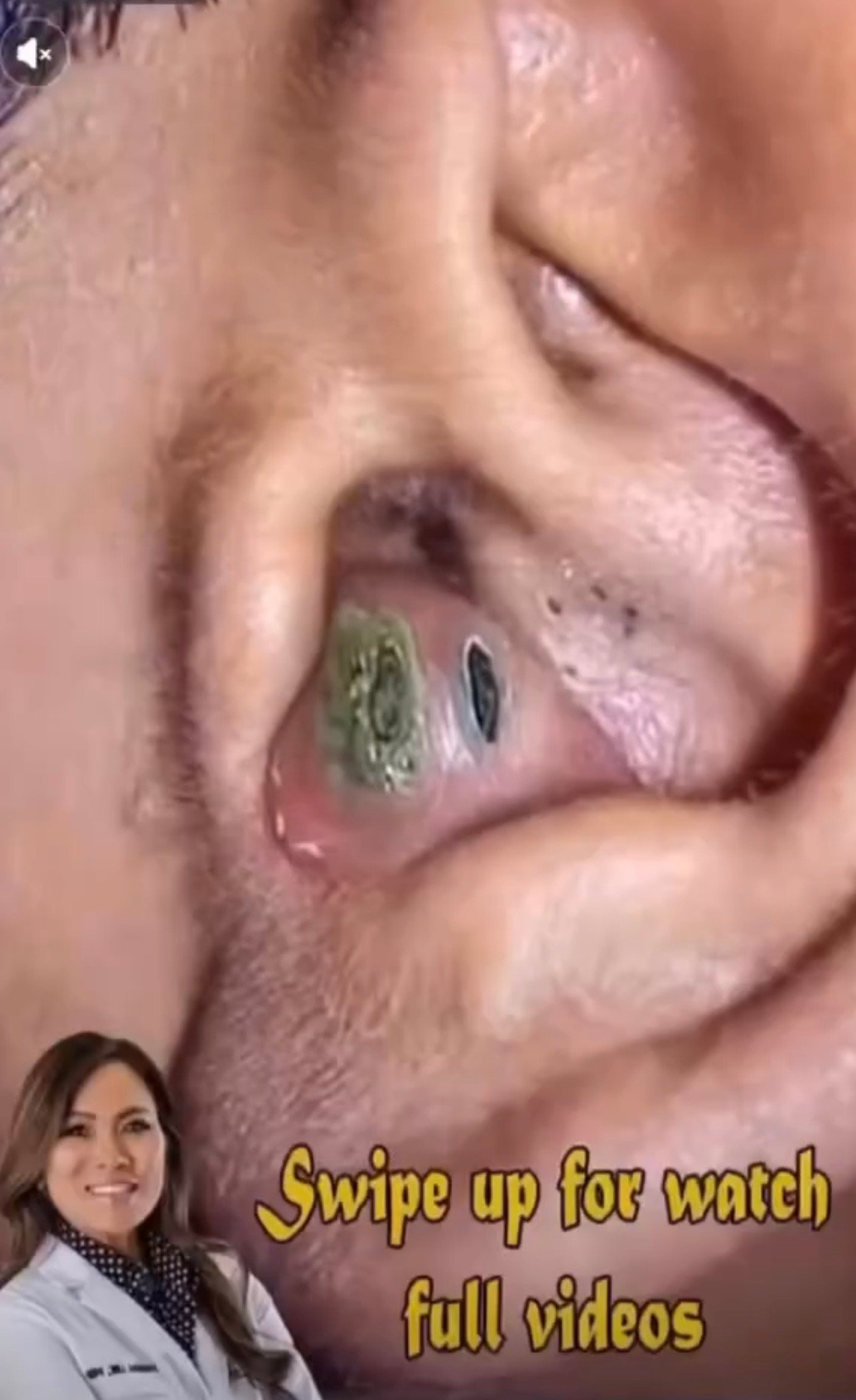 Their acne is severe